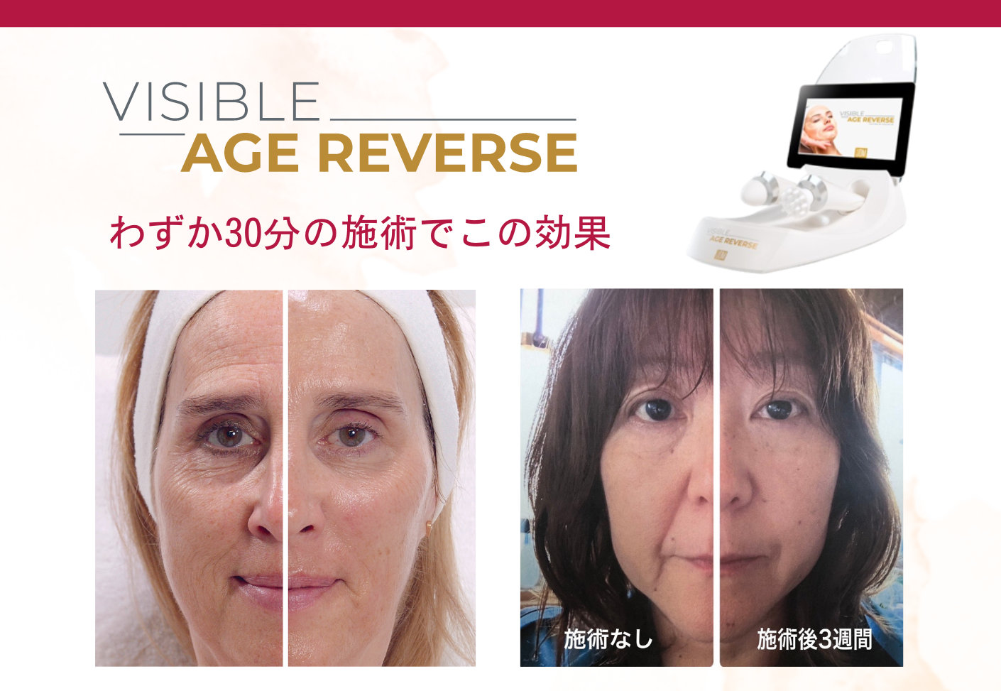 VARビフォーアフター